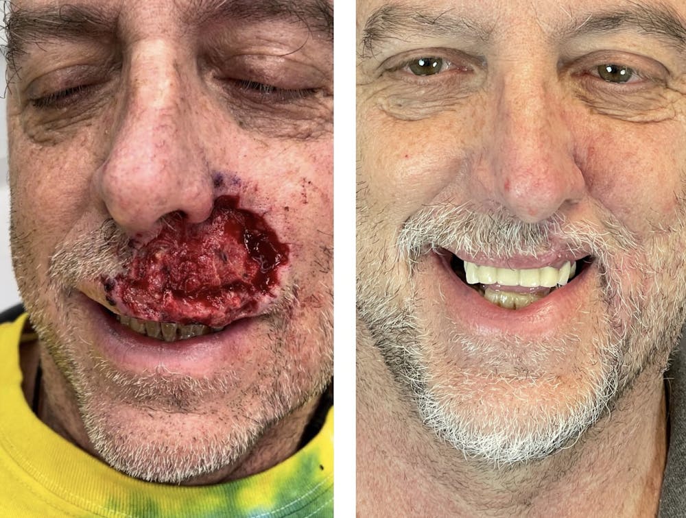 Mohs Reconstruction  Before & After Gallery - Patient 120378258 - Image 1