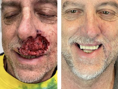 Mohs Reconstruction  Before & After Gallery - Patient 120378258 - Image 1