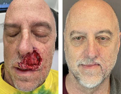Mohs Reconstruction  Before & After Gallery - Patient 120378258 - Image 2