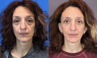 Lower Blepharoplasty Gallery - Patient 120948713 - Image 1