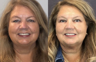 Upper Blepharoplasty Before & After Gallery - Patient 121163717 - Image 1