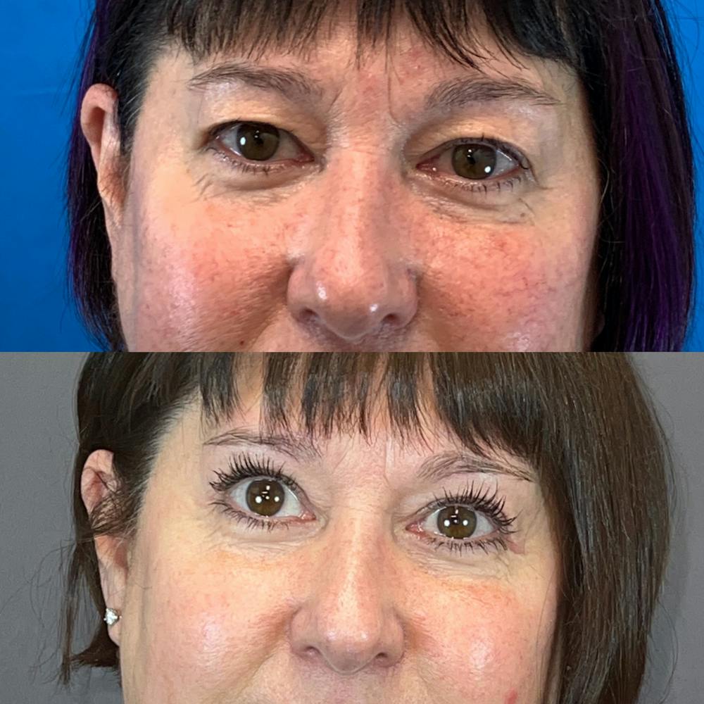 Upper Blepharoplasty Before & After Gallery - Patient 121378111 - Image 1