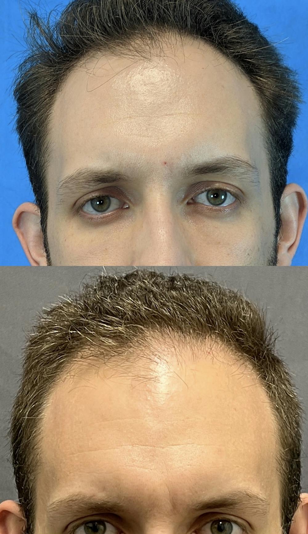 Hair Restoration  Before & After Gallery - Patient 121401564 - Image 1