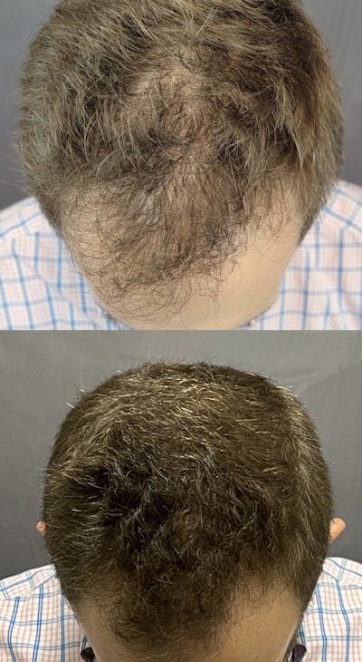Hair Restoration  Before & After Gallery - Patient 121401564 - Image 2