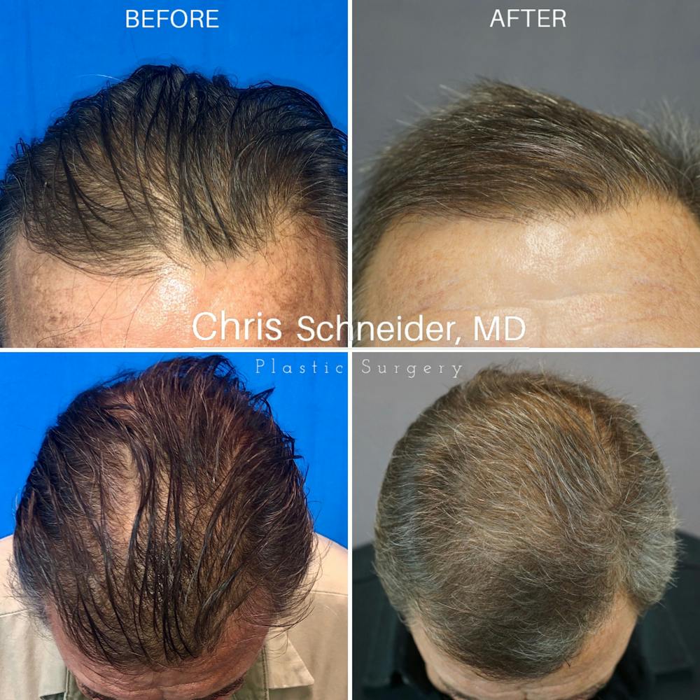 Patient 121501667 | Hair Restoration Before & After Photos | Austin Face &  Body