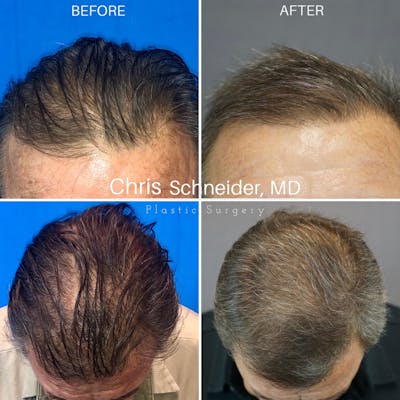 Hair Restoration  Before & After Gallery - Patient 121501667 - Image 1