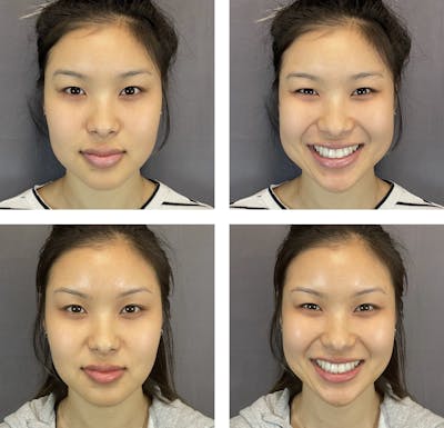 Buccal Fat Reduction Before & After Gallery - Patient 121541466 - Image 1