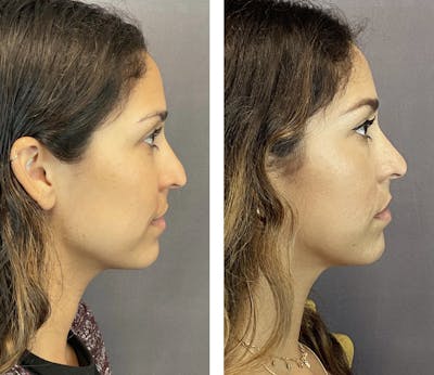 Non-Surgical Rhinoplasty Before & After Gallery - Patient 270231 - Image 1