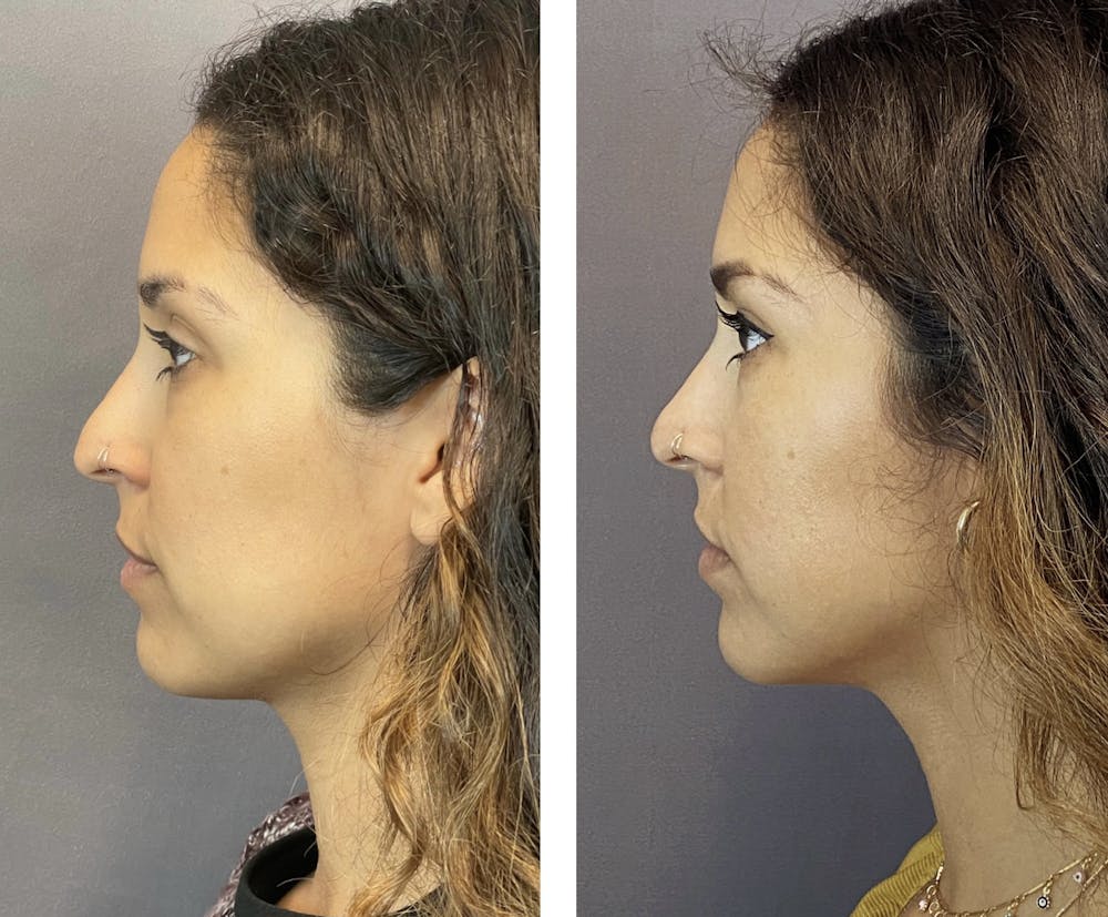 Non-Surgical Rhinoplasty Before & After Gallery - Patient 270231 - Image 2