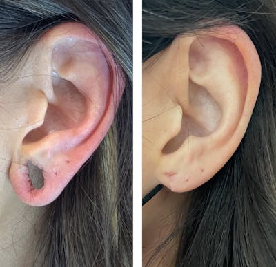 Ear Surgery Before & After Gallery - Patient 121541535 - Image 1
