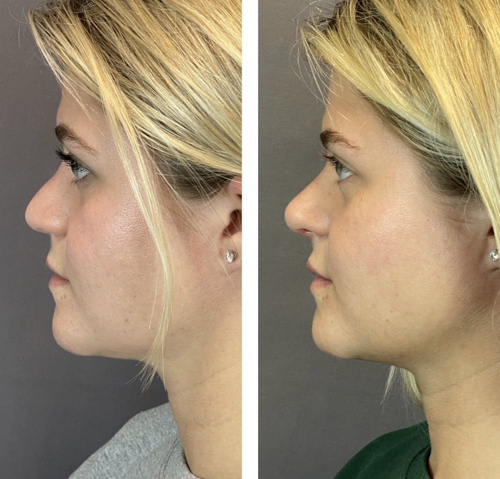 Rhinoplasty Before & After Gallery - Patient 121541664 - Image 6