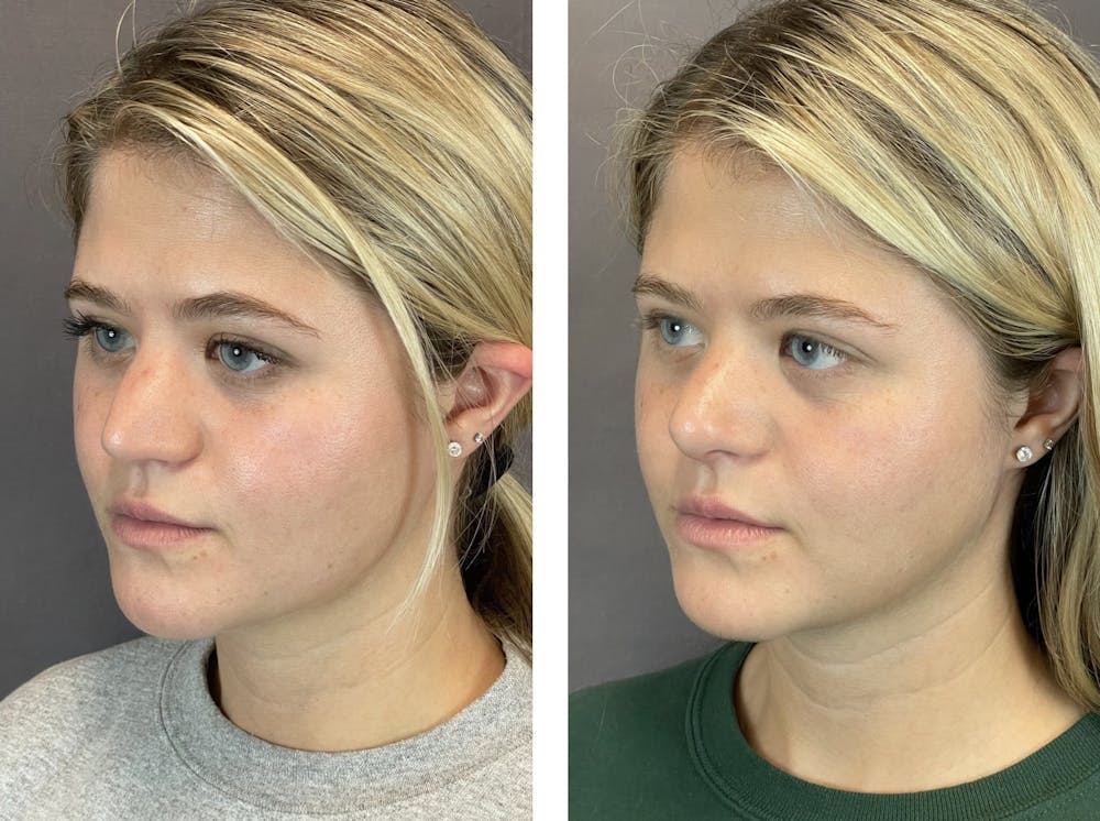 Rhinoplasty Before & After Gallery - Patient 121541664 - Image 3