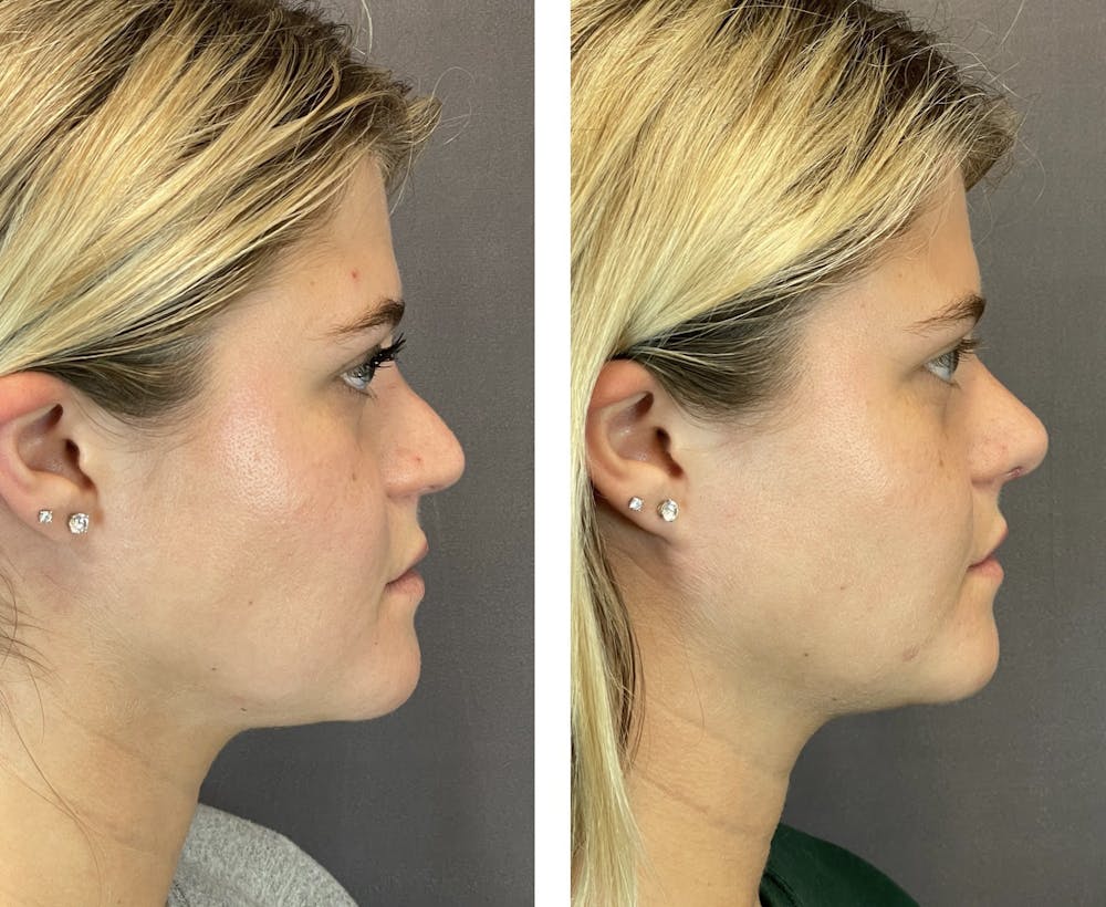 Rhinoplasty Before & After Gallery - Patient 121541664 - Image 1