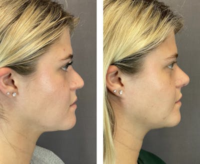 Rhinoplasty Before & After Gallery - Patient 121541664 - Image 1