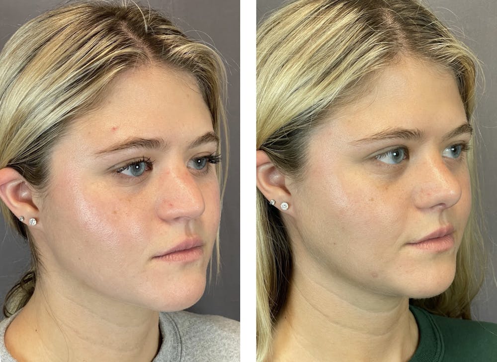 Rhinoplasty Before & After Gallery - Patient 121541664 - Image 5