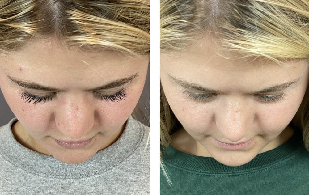 Rhinoplasty Before & After Gallery - Patient 121541664 - Image 7