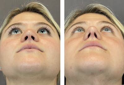Rhinoplasty Before & After Gallery - Patient 121541664 - Image 4