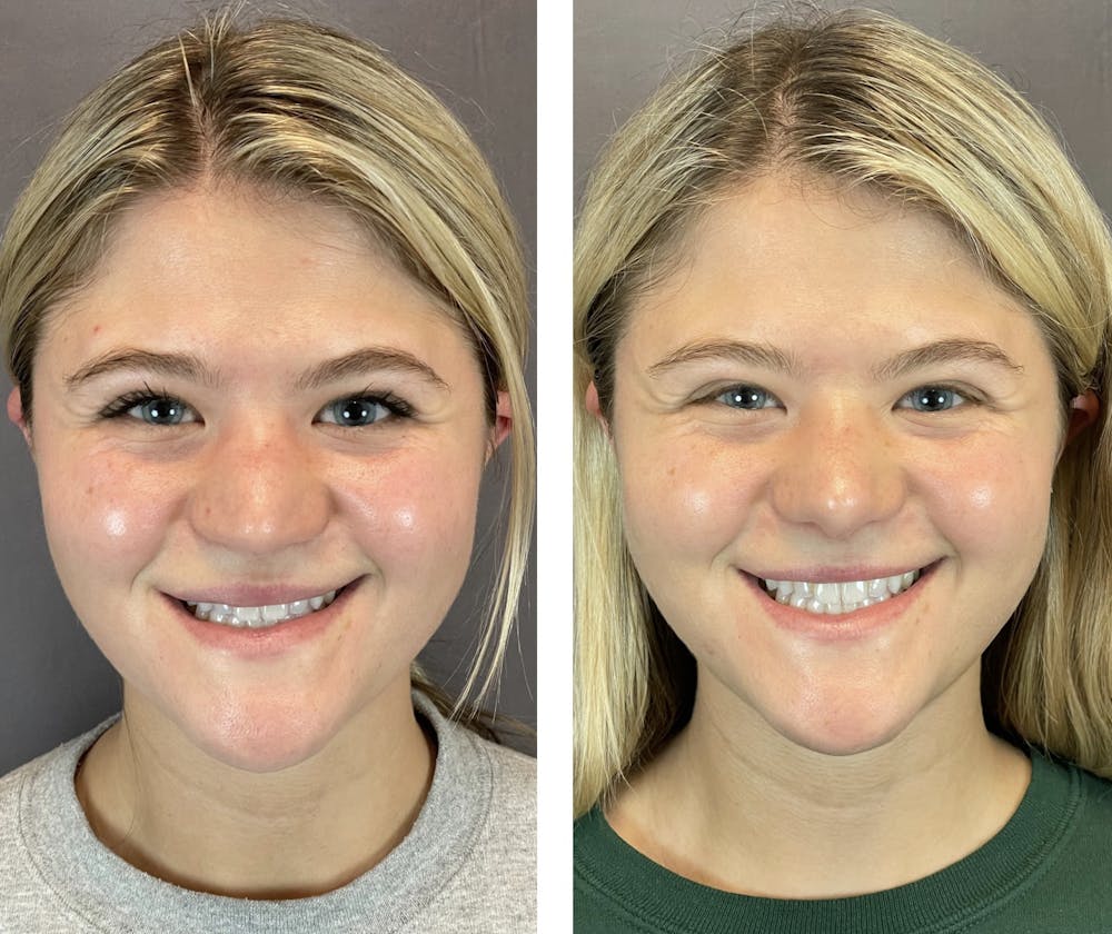 Rhinoplasty Before & After Gallery - Patient 121541664 - Image 8