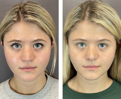 Rhinoplasty Before & After Gallery - Patient 121541664 - Image 2