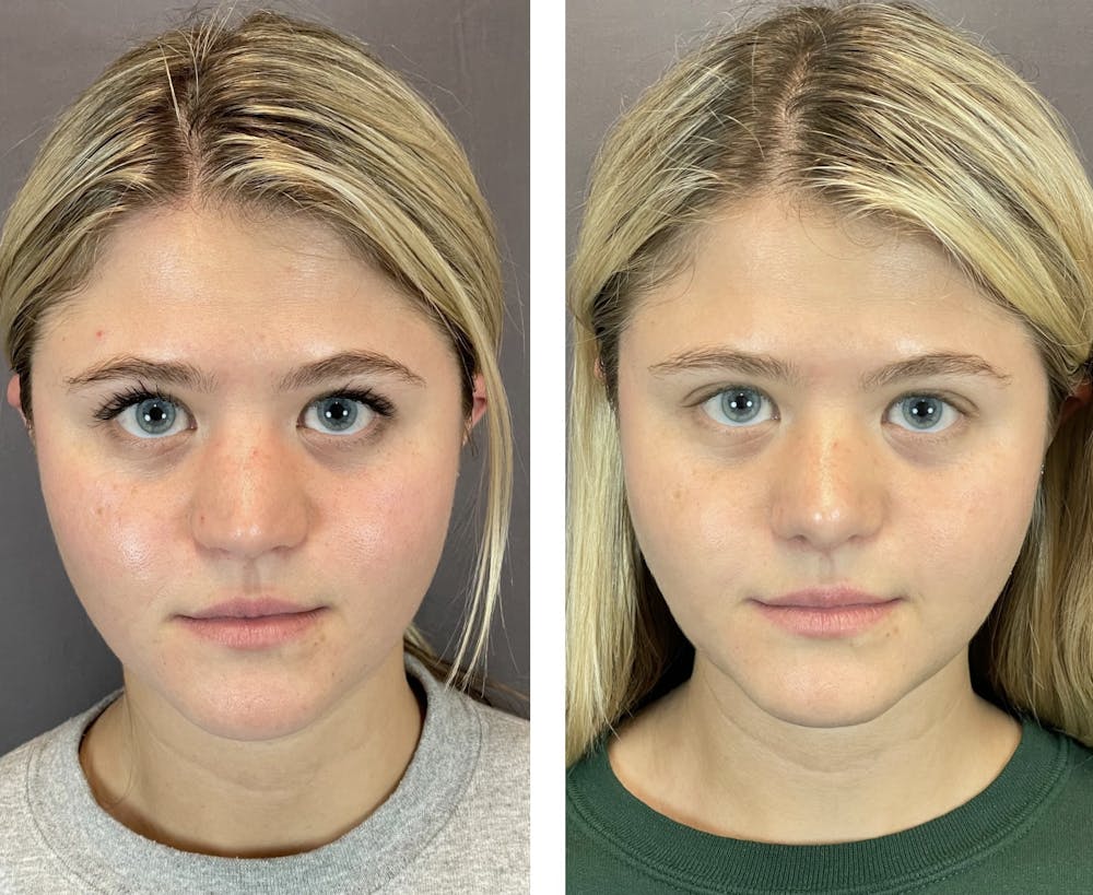 Rhinoplasty Before & After Gallery - Patient 121541664 - Image 2