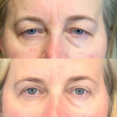Upper Blepharoplasty Before & After Gallery - Patient 121542214 - Image 1