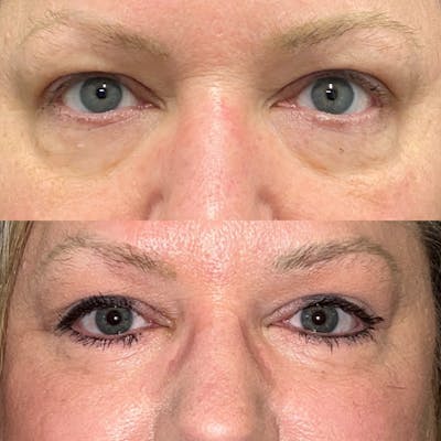 Upper Blepharoplasty Before & After Gallery - Patient 121542231 - Image 1