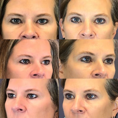 Brow Lift Before & After Gallery - Patient 121817819 - Image 1