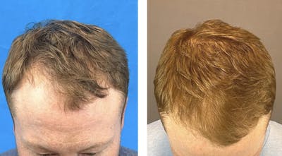 Hair Restoration  Before & After Gallery - Patient 121817845 - Image 1