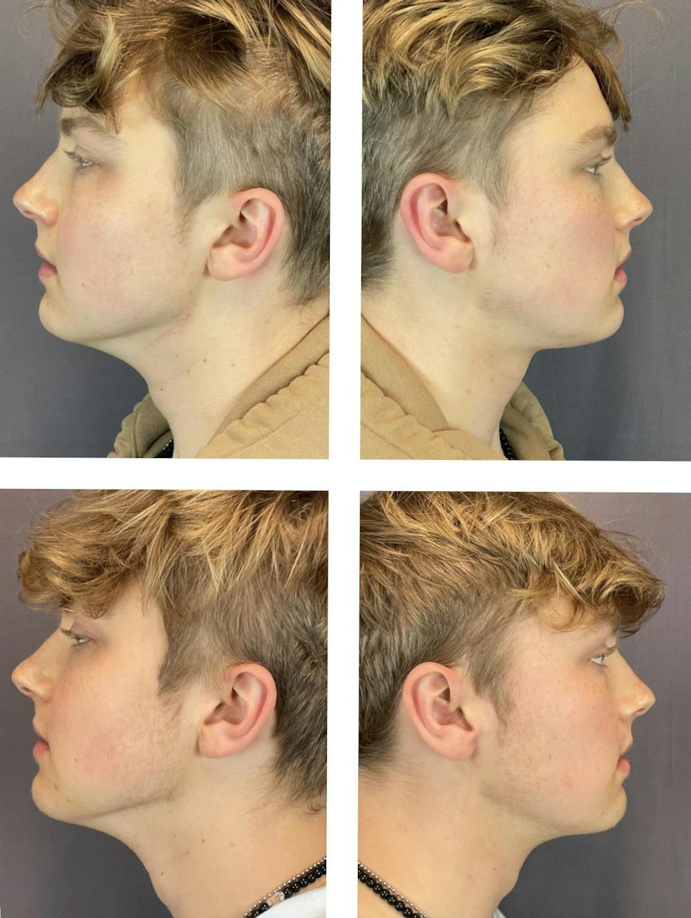 Buccal Fat Reduction Before & After Gallery - Patient 121817865 - Image 3