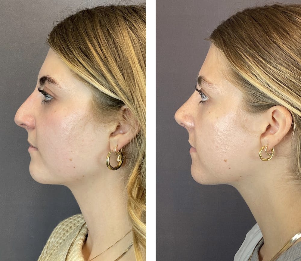 Rhinoplasty Before & After Gallery - Patient 122075948 - Image 2