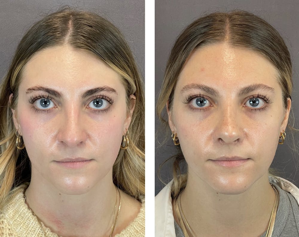 Rhinoplasty Before & After Gallery - Patient 122075948 - Image 3