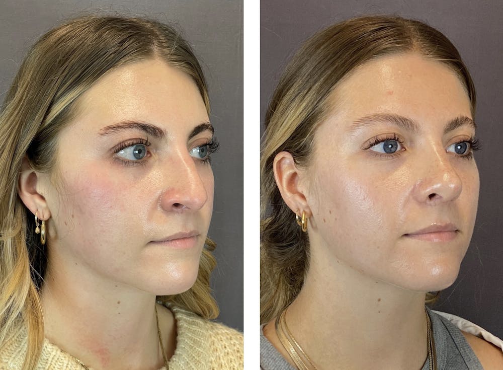 Rhinoplasty Before & After Gallery - Patient 122075948 - Image 4