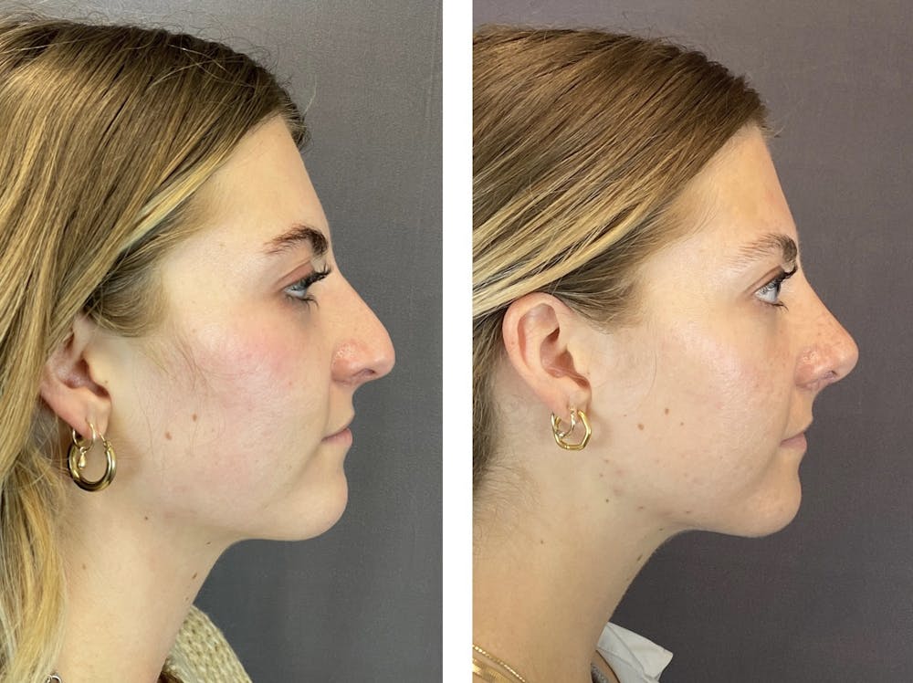 Rhinoplasty Before & After Gallery - Patient 122075948 - Image 1