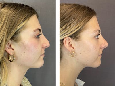Rhinoplasty Before & After Gallery - Patient 122075948 - Image 1