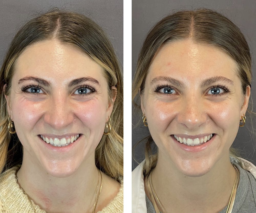 Rhinoplasty Before & After Gallery - Patient 122075948 - Image 5