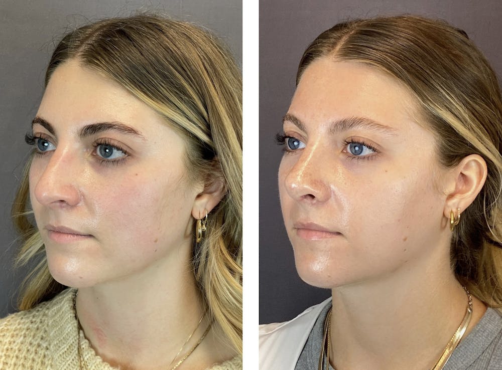 Rhinoplasty Before & After Gallery - Patient 122075948 - Image 6