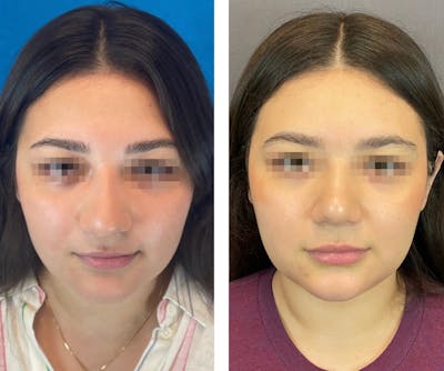 Rhinoplasty Before & After Gallery - Patient 101181747 - Image 2