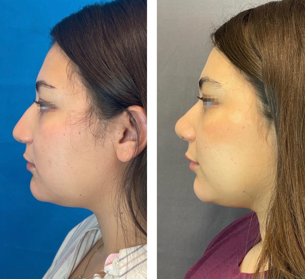 Rhinoplasty Before & After Gallery - Patient 101181747 - Image 3