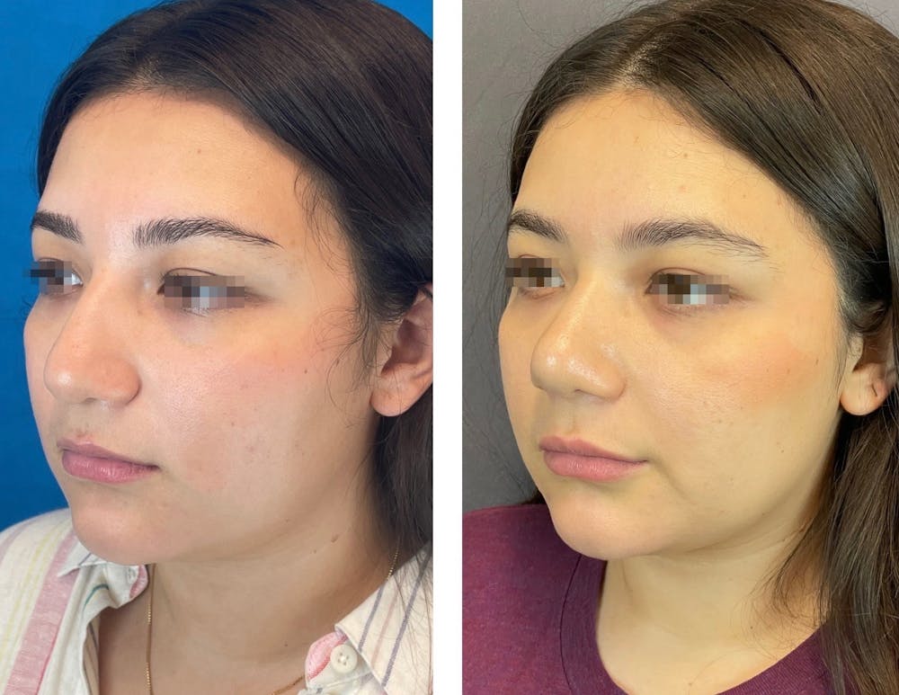 Rhinoplasty Before & After Gallery - Patient 101181747 - Image 4