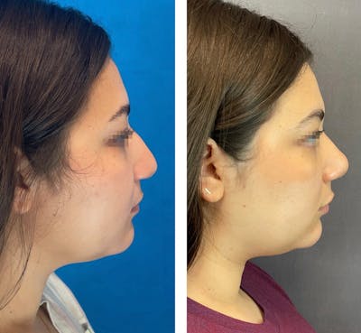 Rhinoplasty Before & After Gallery - Patient 101181747 - Image 1