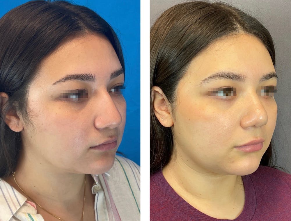 Rhinoplasty Before & After Gallery - Patient 101181747 - Image 5