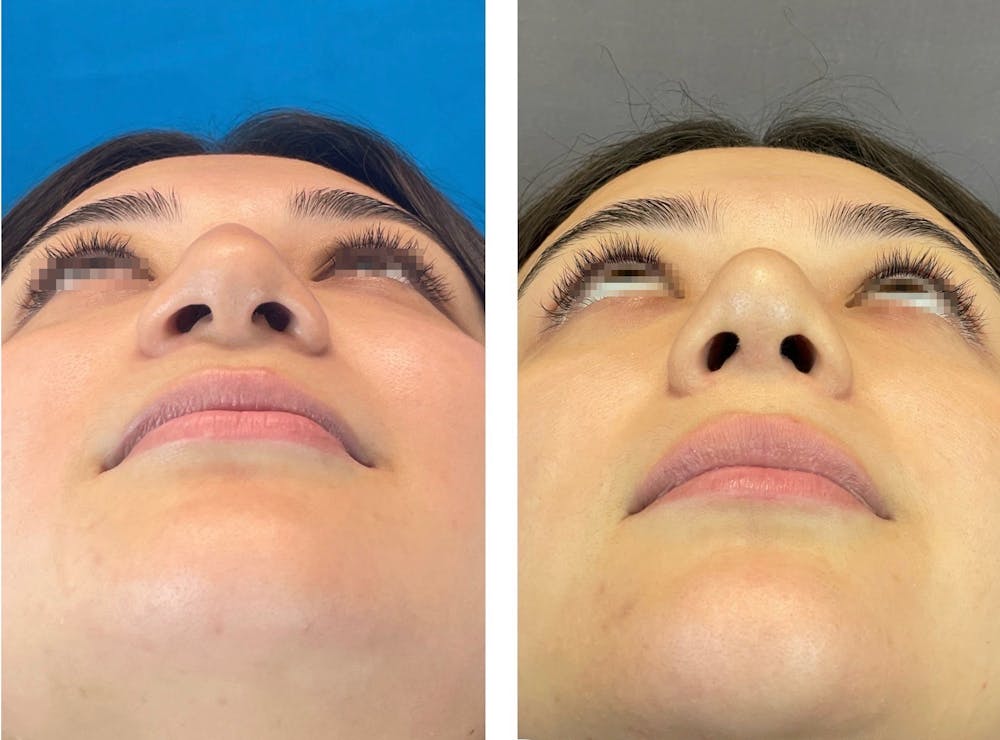 Rhinoplasty Before & After Gallery - Patient 101181747 - Image 7