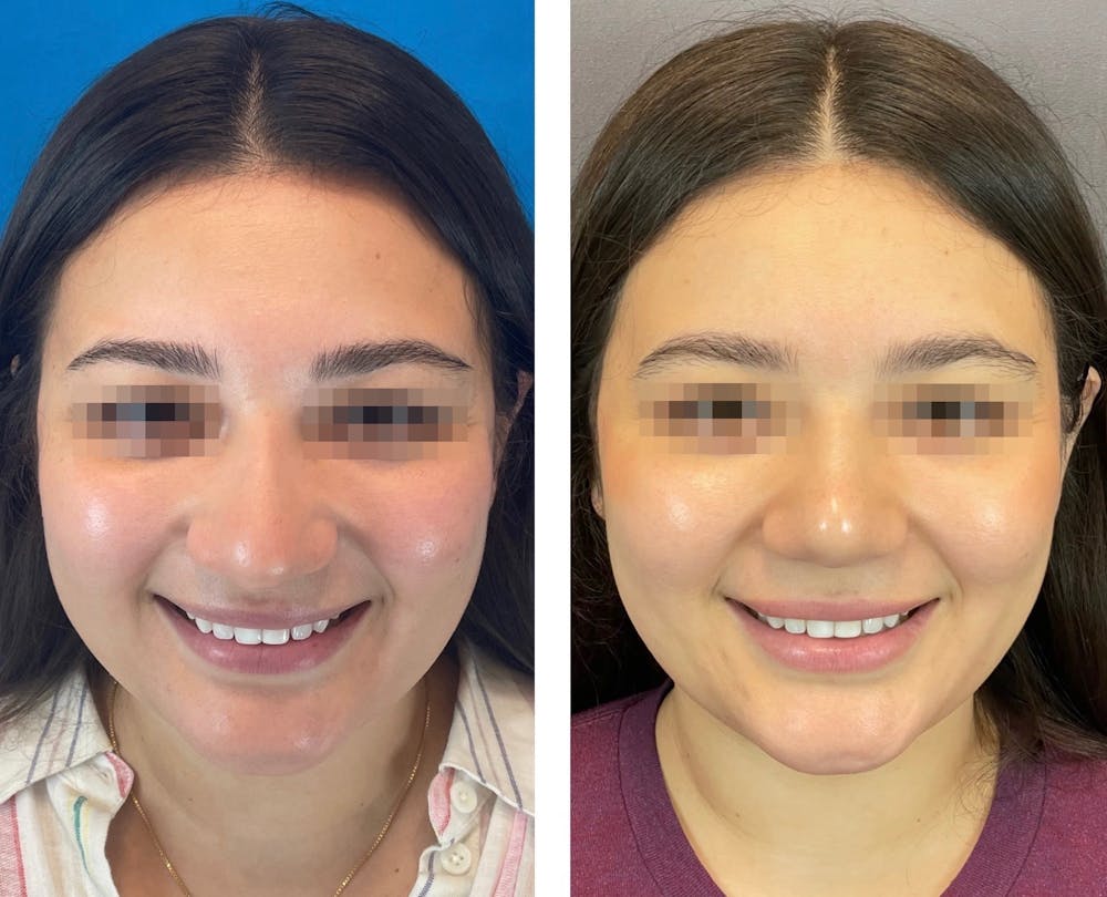 Rhinoplasty Before & After Gallery - Patient 101181747 - Image 8