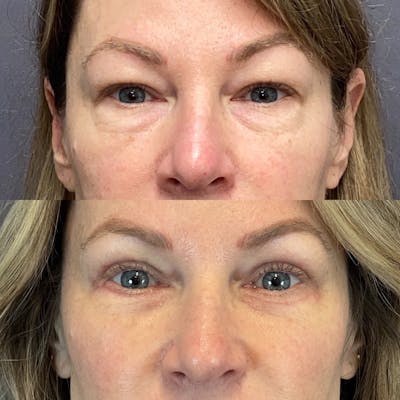Upper Blepharoplasty Before & After Gallery - Patient 122075978 - Image 1