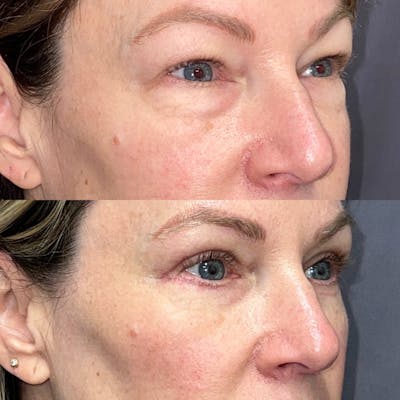 Upper Blepharoplasty Before & After Gallery - Patient 122075978 - Image 2