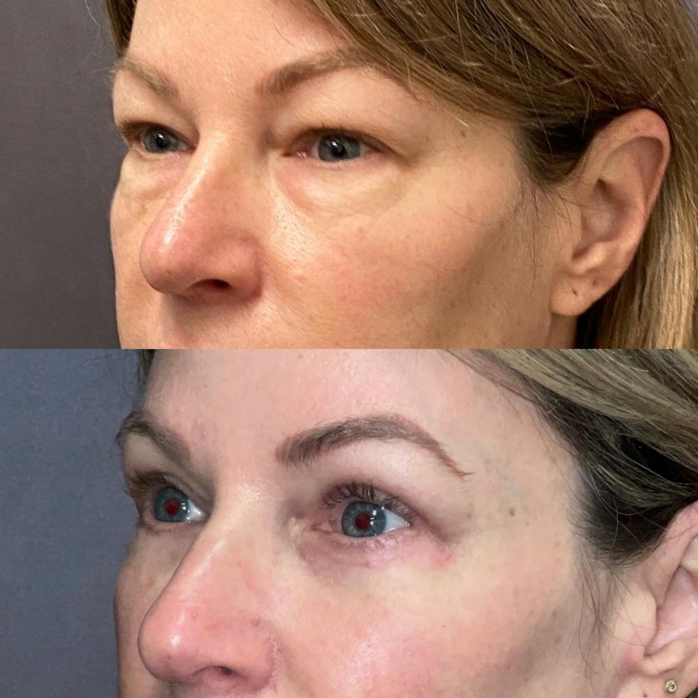 Upper Blepharoplasty Before & After Gallery - Patient 122075978 - Image 3