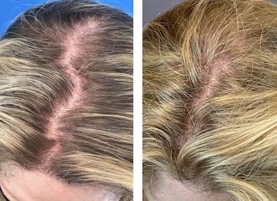 Hair Restoration  Before & After Gallery - Patient 144658924 - Image 1