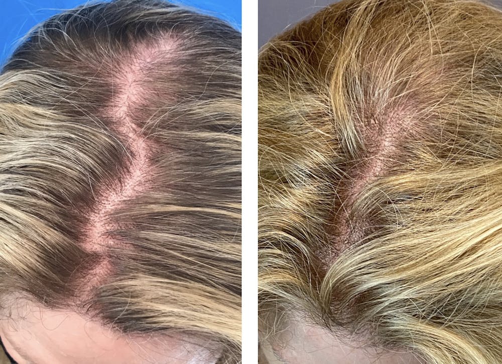 Hair Restoration  Before & After Gallery - Patient 144658924 - Image 1