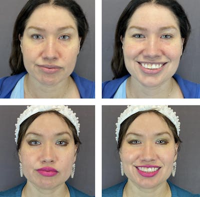 Buccal Fat Reduction Before & After Gallery - Patient 122127312 - Image 1