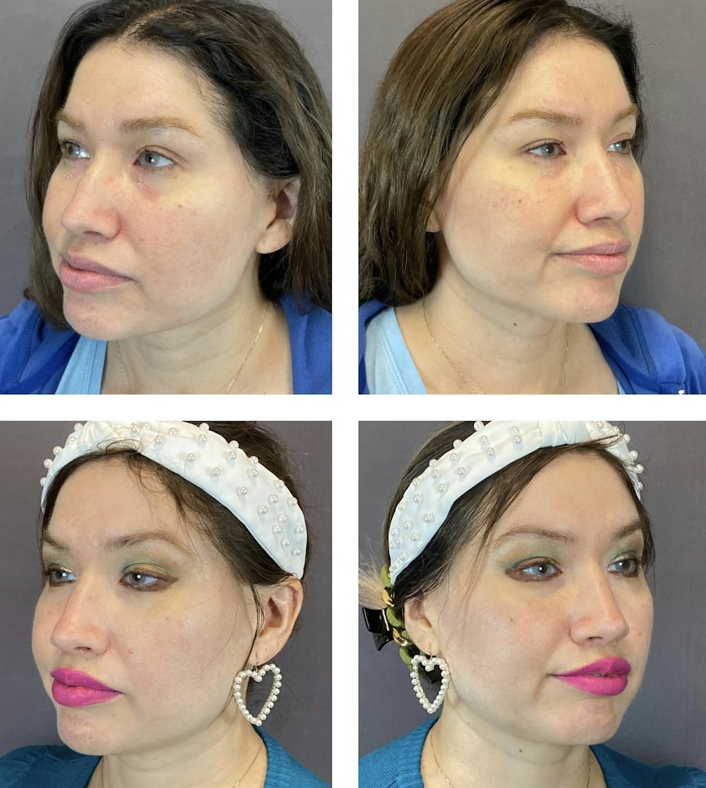 Buccal Fat Reduction Before & After Gallery - Patient 122127312 - Image 2